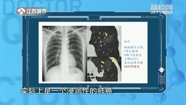 医院检查X光和CT有啥区别?一张图带你快速了解