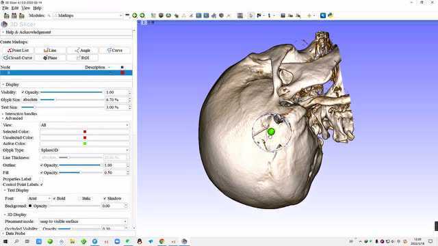 3DSlicer快速开骨窗模拟入路教程(文末视频)