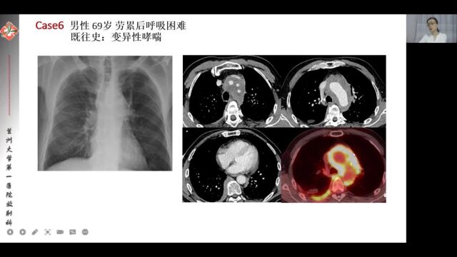 主动脉壁增厚相关鉴别诊断兰州大学第一医院王刚