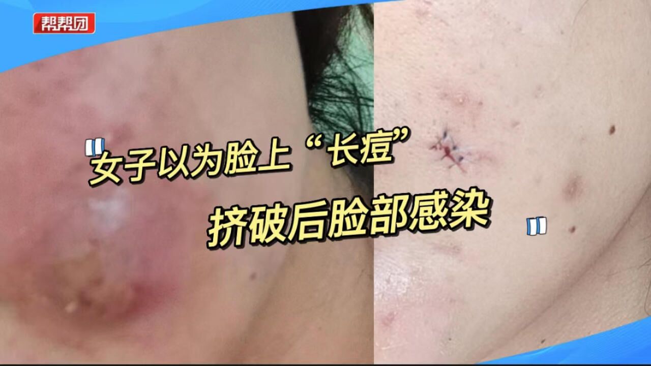 警惕!女子以为脸上长“痘痘”,粉刺针挑破后导致脸部感染