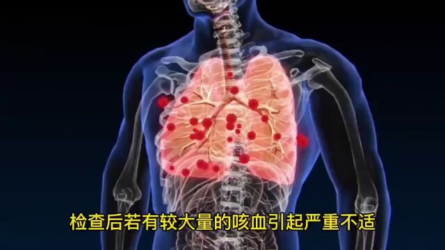 【聚焦中医】125I粒子支架植入术 为食管癌治疗上双保险