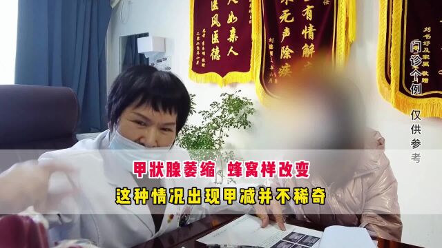 王克珍医生:甲减是什么原因引起的?分析两种情况,教您早期识别!