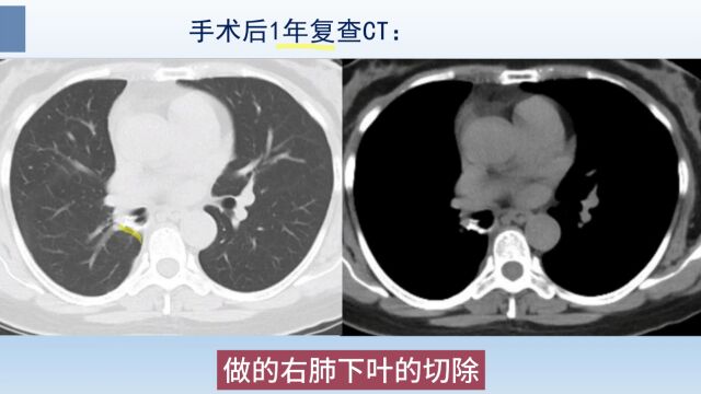 肺炎型肺癌CT征象分析,这种肺癌像肺炎,但抗生素治疗无效