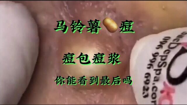 我远方的表妹长了两个马铃薯大的痘痘粉刺黑头,一挤有两斤多#解压 #黑头粉刺 #挤痘痘 #歌手王家太#创作灵感