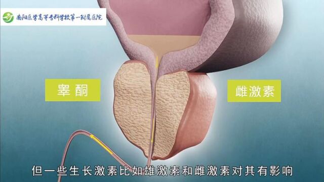 前列腺增生科普动画