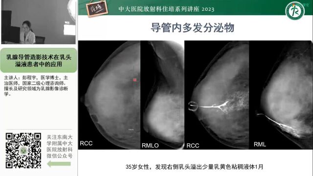 乳腺X线导管造影技术在乳头溢液患者中的应用中大彭程宇