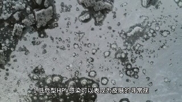 HPV病毒感染的症状 成都锦一医院