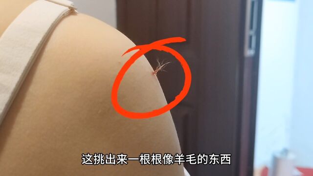 羊毛疔挑刺疗法培训教学教程视频