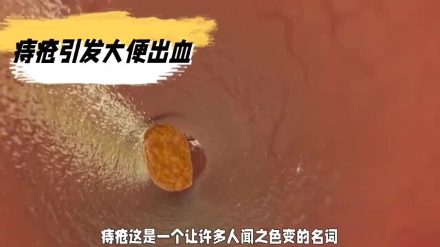 痔疮引发大便出血?