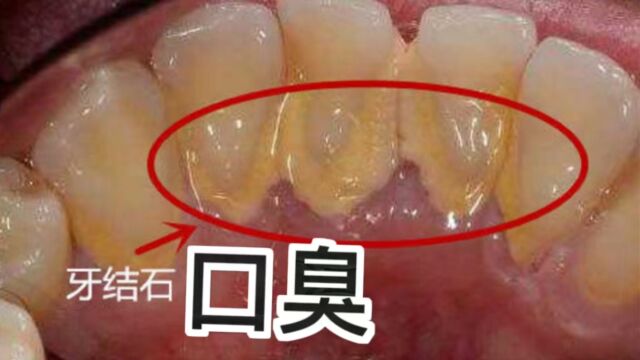 上班族牙结石口臭影响社交?快试试这三招!短时间实现口气清新!