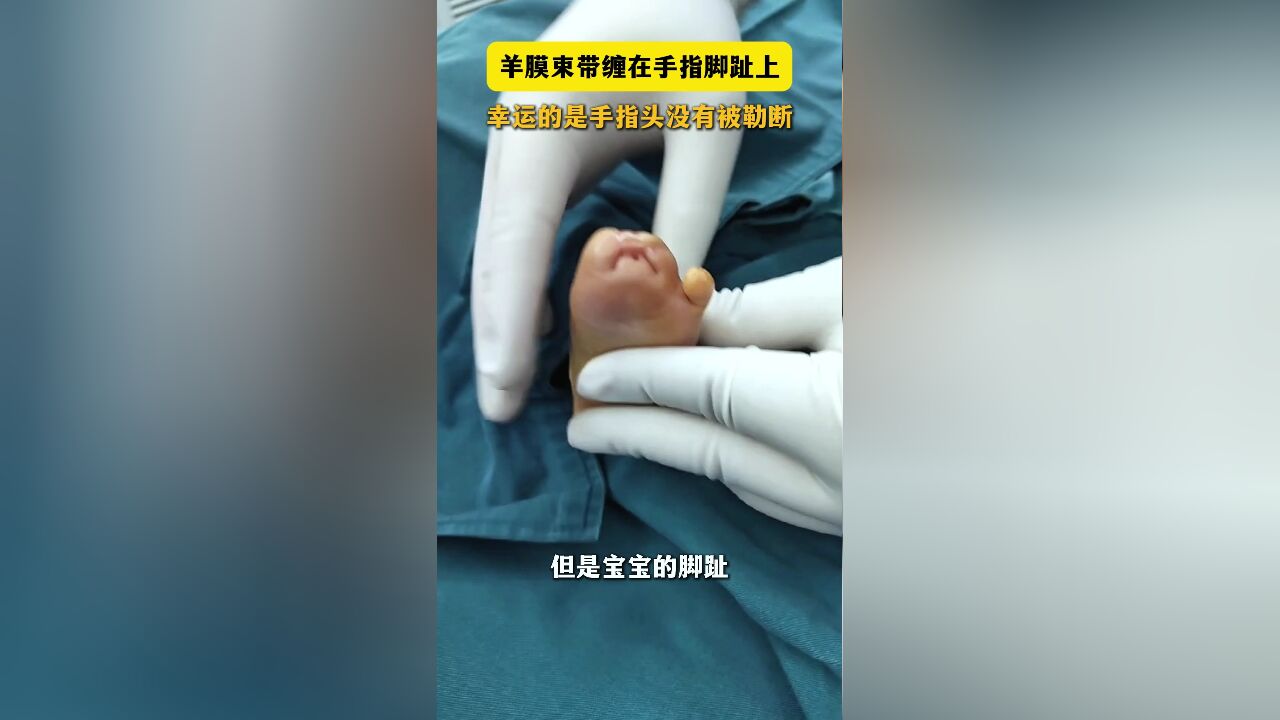 羊膜束带缠在手指脚趾上,幸运的是手指头没有被勒断