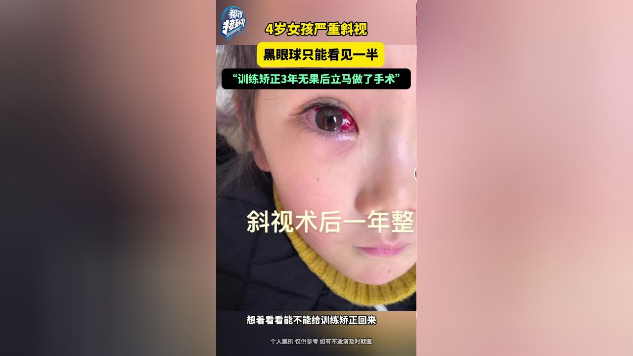 4岁女孩严重斜视 黑眼球只能看见一半 矫正3年无果后去做了手术