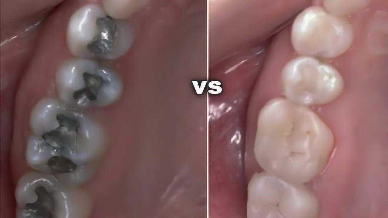 树脂补牙的全过程，树脂补牙是最好的补牙方法！_腾讯视频