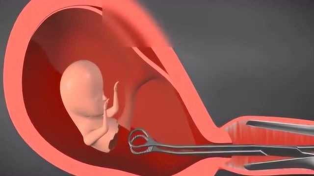 人工流产手术的3D动画演示,看完觉得去做的是在残害生命