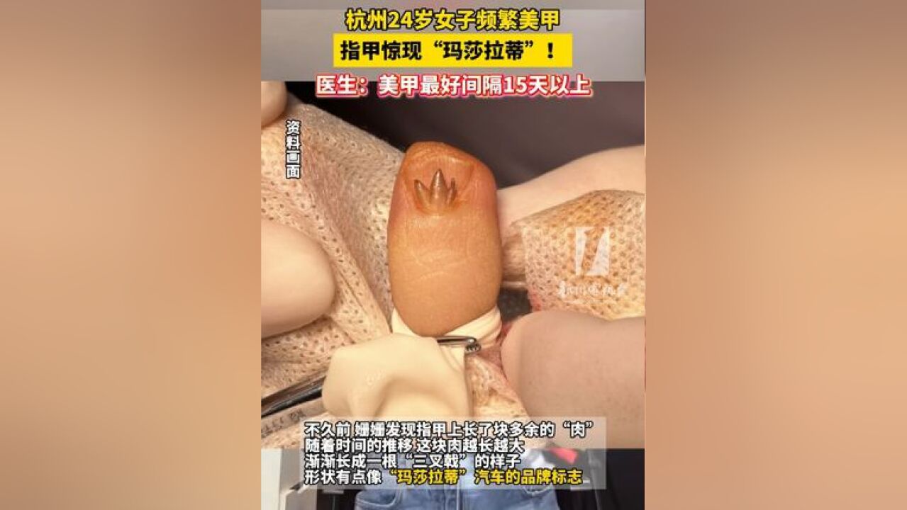 杭州 24岁女子频繁美甲 ,指甲惊现“玛莎拉蒂 ”!医生:美甲最好间隔15天以上