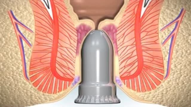 医学科普,痔疮的治疗?