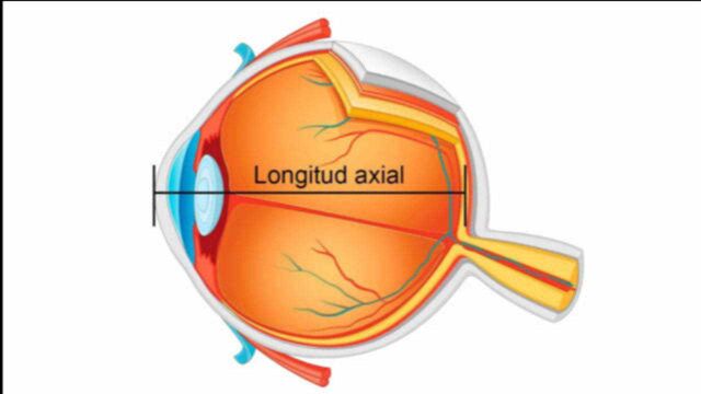 眼轴长度与近视和年龄的关系