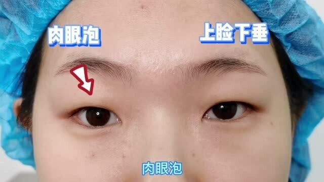 埋线双眼皮修复