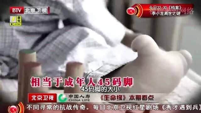 男童的脚,相当于成年人45码的脚,脚趾面目全非!