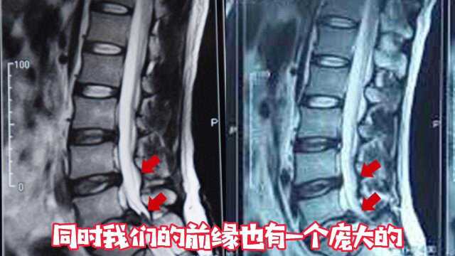 腰椎间盘突出症ct,核磁共振讲解