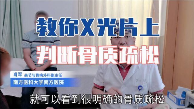 骨科教授分享:你能学会的看片技巧!X光片上怎样判断骨质疏松?