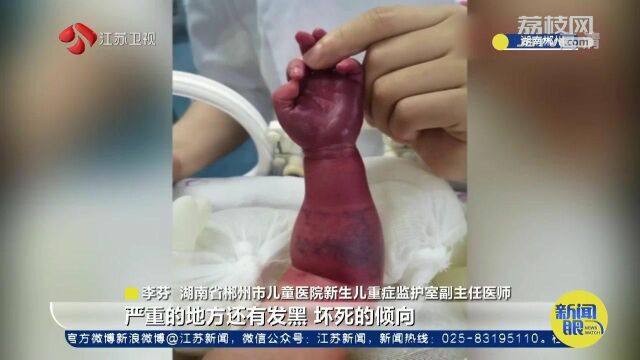 婴儿出生一天手臂肿胀险截肢 医生:这些老旧观念容易出问题