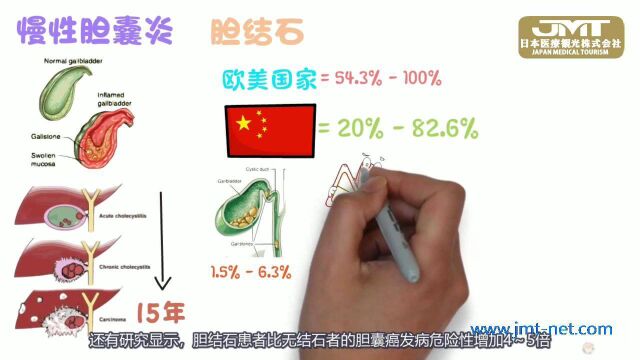 JMT日本医疗签证胆囊癌的相关疾病之胆结石