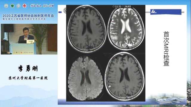 血液病脑部病变影像诊断思路苏州大学附属第一医院李勇刚