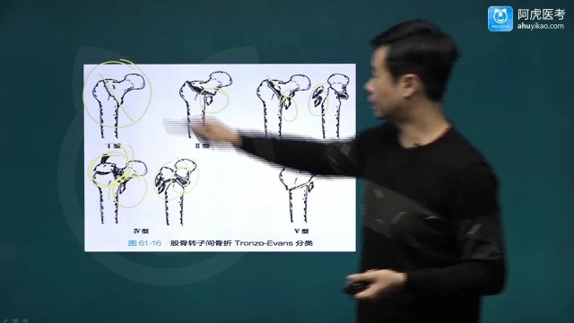 2022年阿虎医考骨外科主治医师中级考试培训 下肢骨折及关节损伤股骨间转子骨折