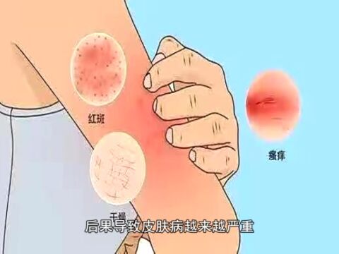 【关注健康】夏季皮肤病防治