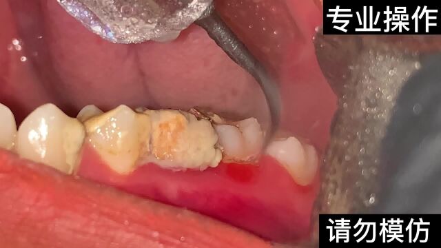 [干饭勿看]18岁小姐姐的牙垢清理