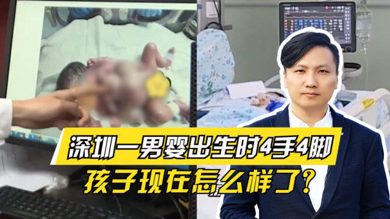 全球罕见!深圳一男婴出生时4手4脚,发生概率为50万分之一