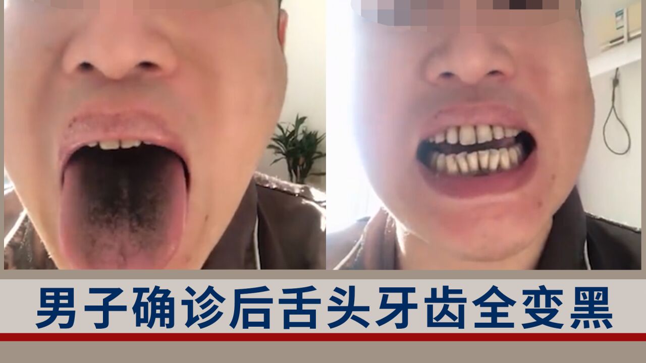 男子确诊后舌头牙齿全变黑:或因免疫力降低再加上抽烟所致