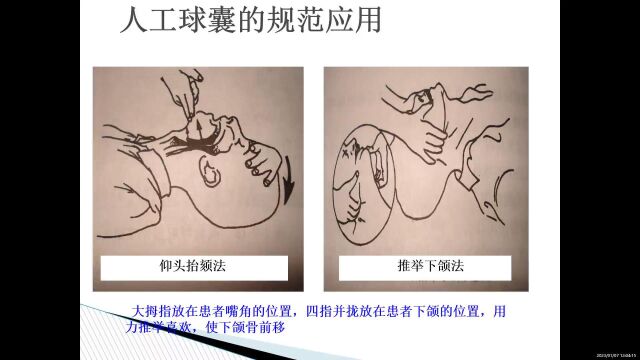 人工球囊的使用与维护(总院ICU)