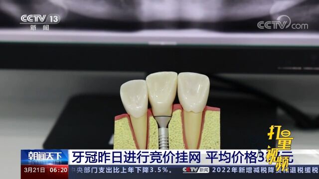 牙冠20日进行竞价挂网,拟入围产品平均价格327元