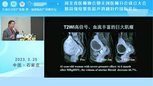 【复旦大学附属徐汇医院】许永华教授—多组学预测和评估子宫肌瘤和FUAS疗效和对策