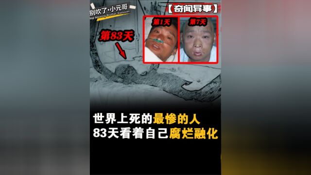 世界上死的最惨的人!被近距离高强度核辐射,在83天内腐烂融化6