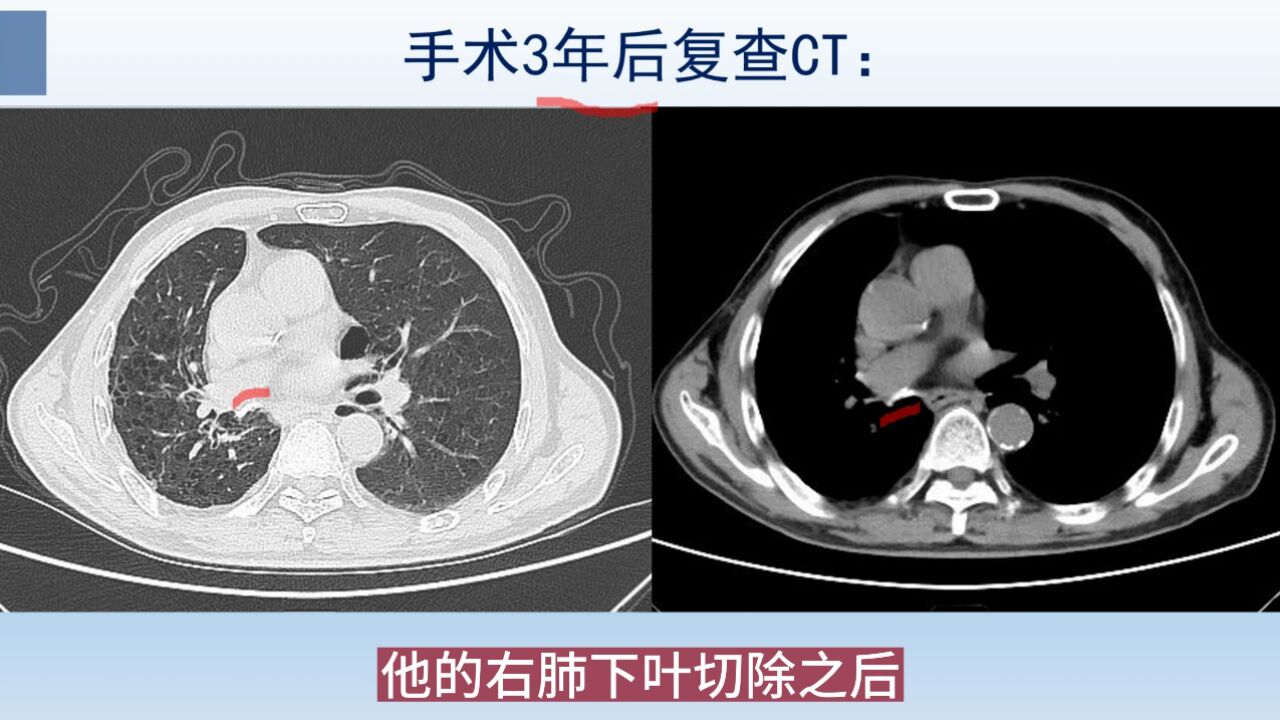 成年人反复肺炎,要做2个检查,排除隐蔽的肺癌