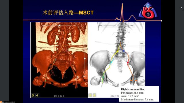 TAVR第一次课程2023.06.15