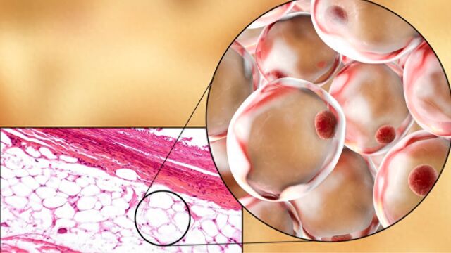 脂肪瘤多为良性,要不要手术切掉?医生:1种情况有必要手术