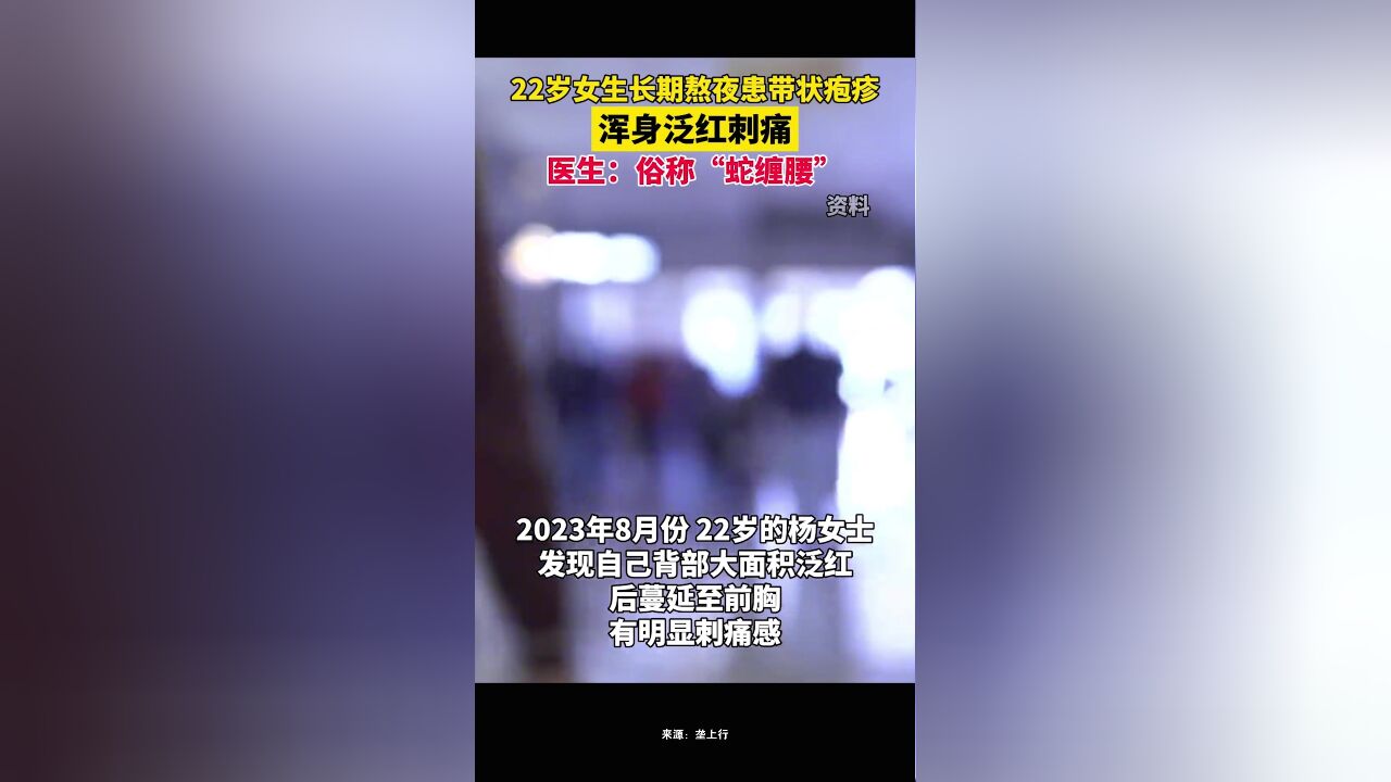 22岁女生长期熬夜患带状疱疹,浑身泛红刺痛,医生:俗称“蛇缠腰”