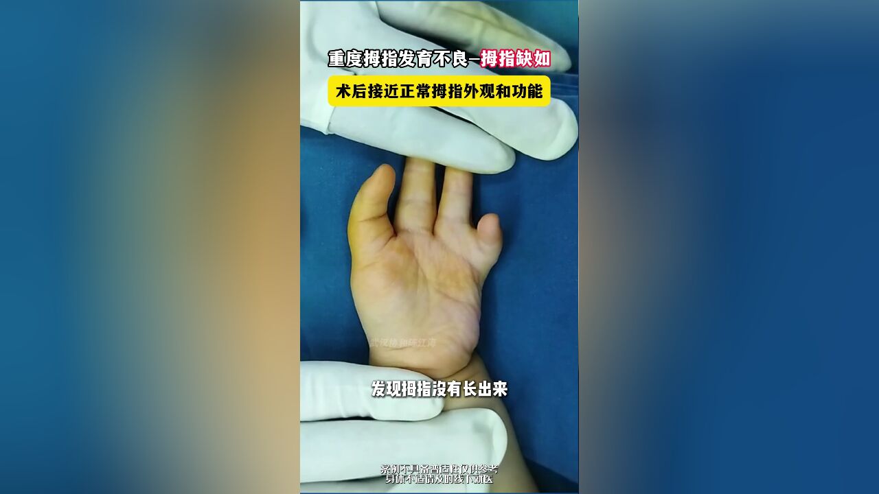 重度拇指发育不良拇指缺如,术后接近正常拇指外观和功能