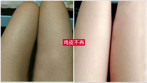 毛囊角质毛周角化 腾讯视频
