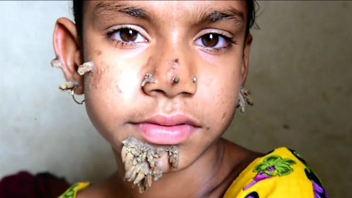 小女孩脸上长出树皮 竟是世界罕见病症