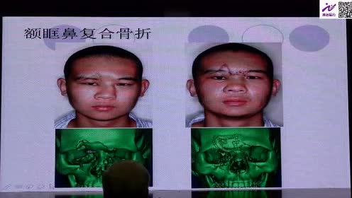 鼻骨折 腾讯视频