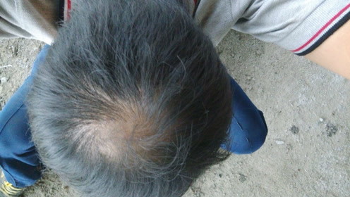 脱发,贫血,肝硬化,就吃点这种鱼,一条鱼全部搞定