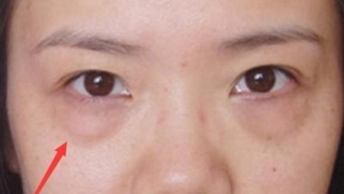 怎样才能去除眼袋 腾讯视频