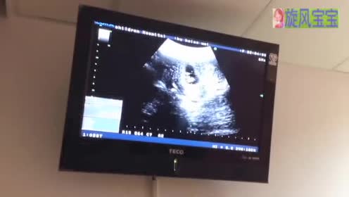 13周胎儿 腾讯视频
