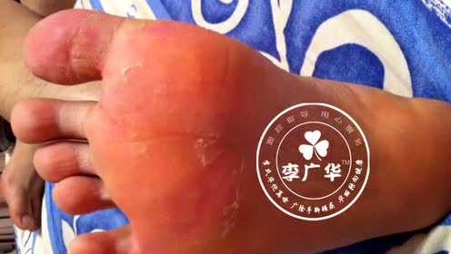 李广华好趾疣 腾讯视频