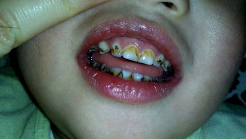 如果不好好刷牙,口腔里真的会长满虫子吗?今天可算知道了